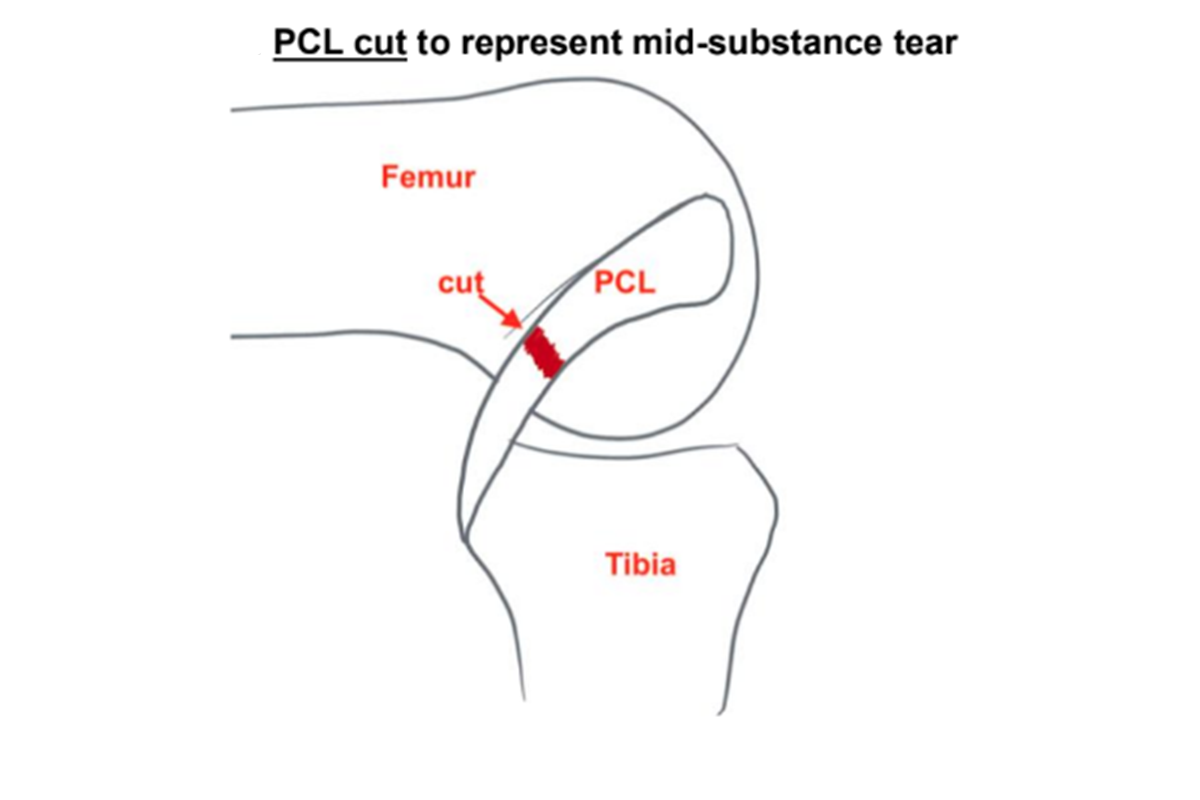 PCL cut to represent mid-substance tear