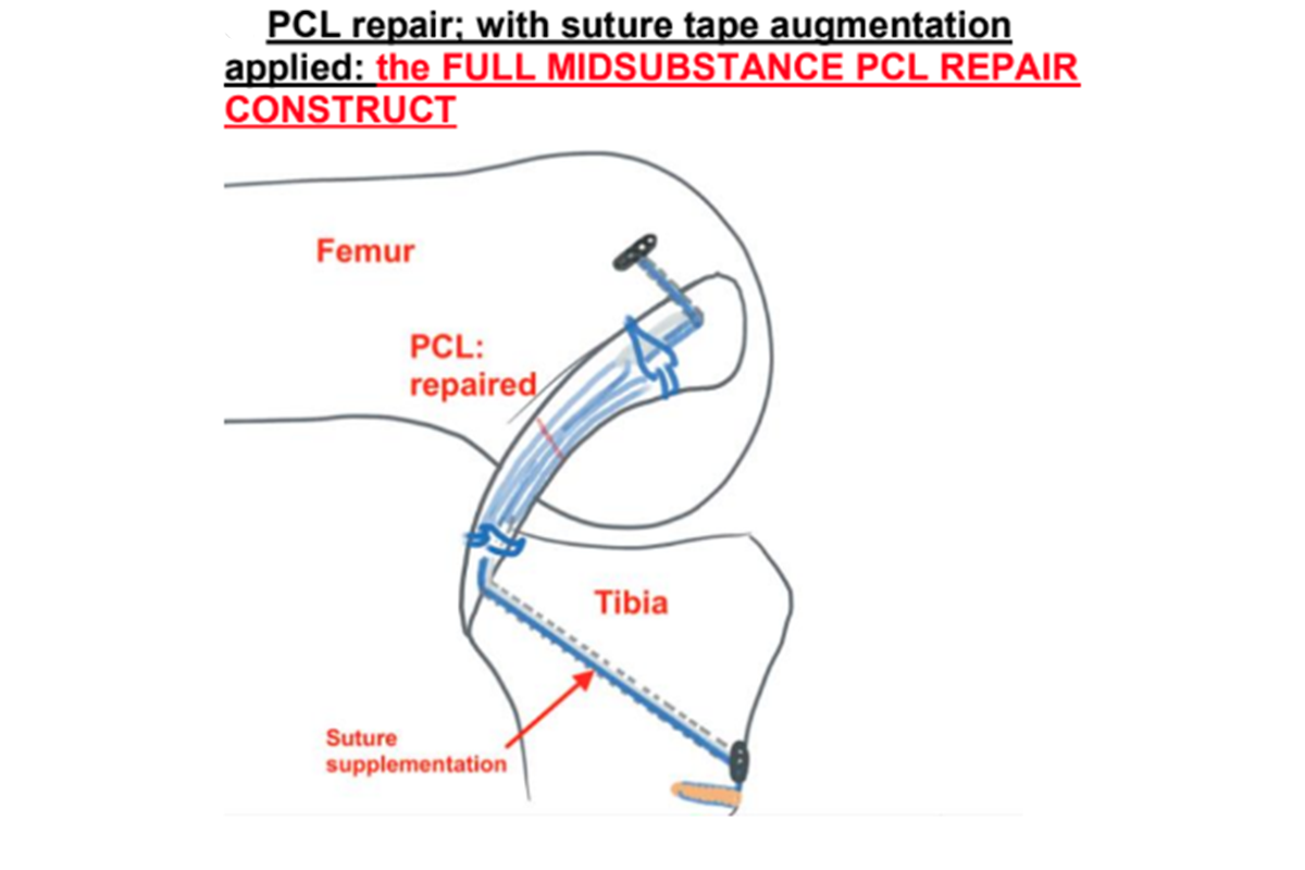 PCL repair with suture tape augmentation applied